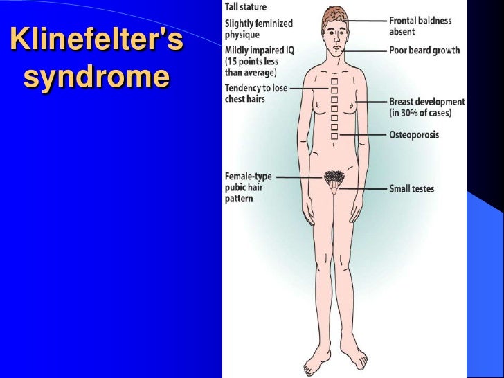 the symptoms and effects of klinefelter syndrome a genetic disorder affecting males Klinefelter syndrome is a chromosome disorder affecting males in which men with the condition have an extra x chromosome. the symptoms and effects of klinefelter syndrome a genetic disorder affecting males Klinefelter syndrome is a chromosome disorder affecting males in which men with the condition have an extra x chromosome.